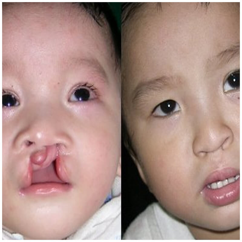 Cleft Simulation Hands-on Workshop